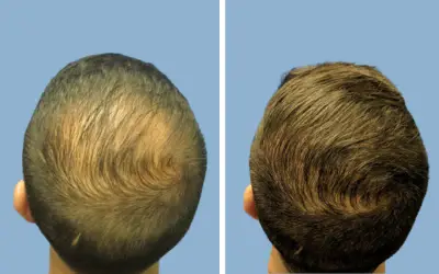 Before and After